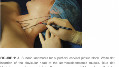 경신경총 cervical plexus block 차단