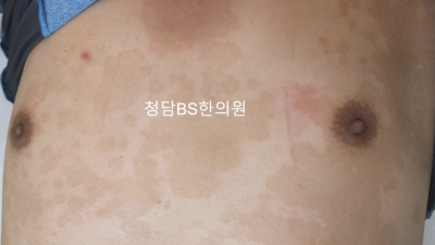안산 어루러기 청담 BS한의원 / 어르러기 아닙니다
