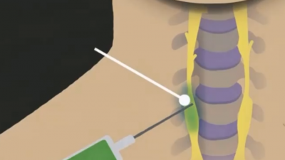 성상신경절차단술(SGB:stellate ganglion block)