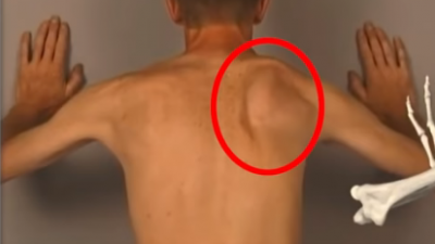 충돌증후군, 라운드숄더 impingement round shoulder 운동법