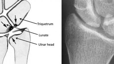 Ulnocarpal impaction syndrome 척골 충돌증후