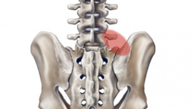 장요인대증후군,  후관절 경막의 통증패턴, iliolumbar ligament