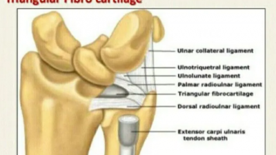 TFCC 파열로 인한 손목 통증, 비수술 치료법으로 증상 개선  삼각섬유연골 파열 수술