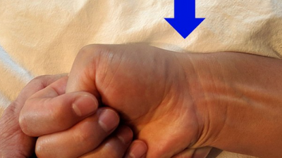 드퀘르벵 De Quervain syndrome 손목건초염